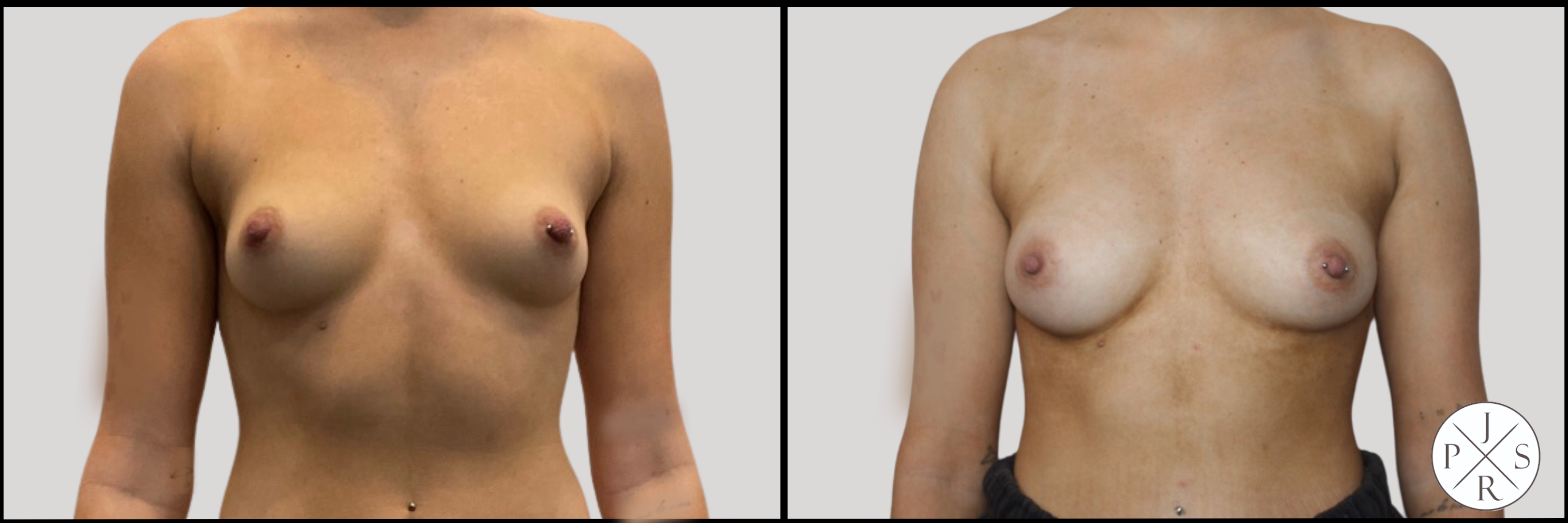 Fat Transfer Breast Augmentation Before & After Image